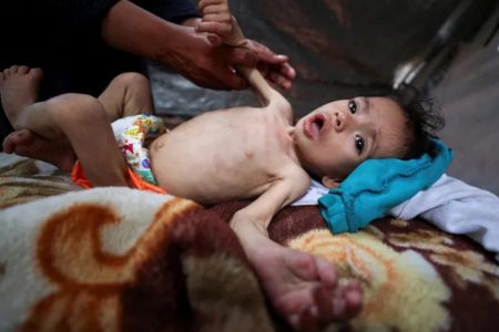 سوء التغذية يفتك بأطفال غزة