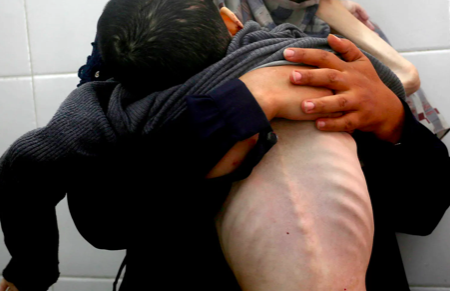 حصاد التجويع المنهجي لقطاع غزة