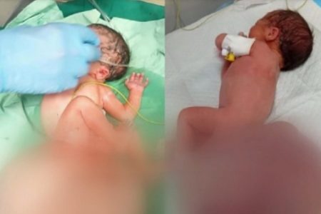 الطبيب الاخصائي عدوان البرغوثي يتحدث لـ “نساء إف إم” عن مخلفات اسلحة تشوه “الأجنة” في غزة !